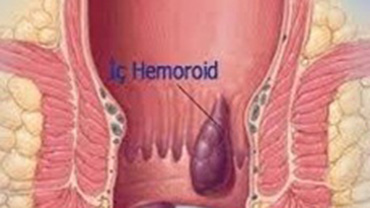 Hemoroid Kremi