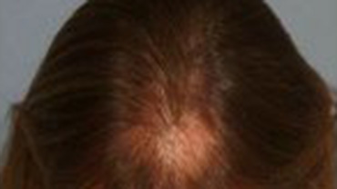 Kadınlarda Androgenik Saç Dökülmesi - 3