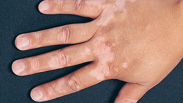 Vitiligo’da Bitkisel Çözümler
